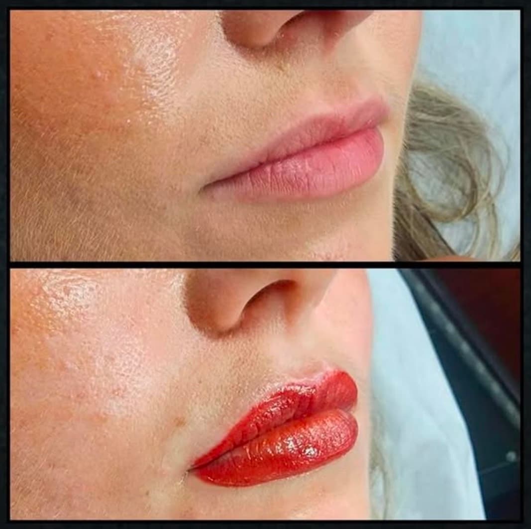 Medium tattoo laser removal by Kat