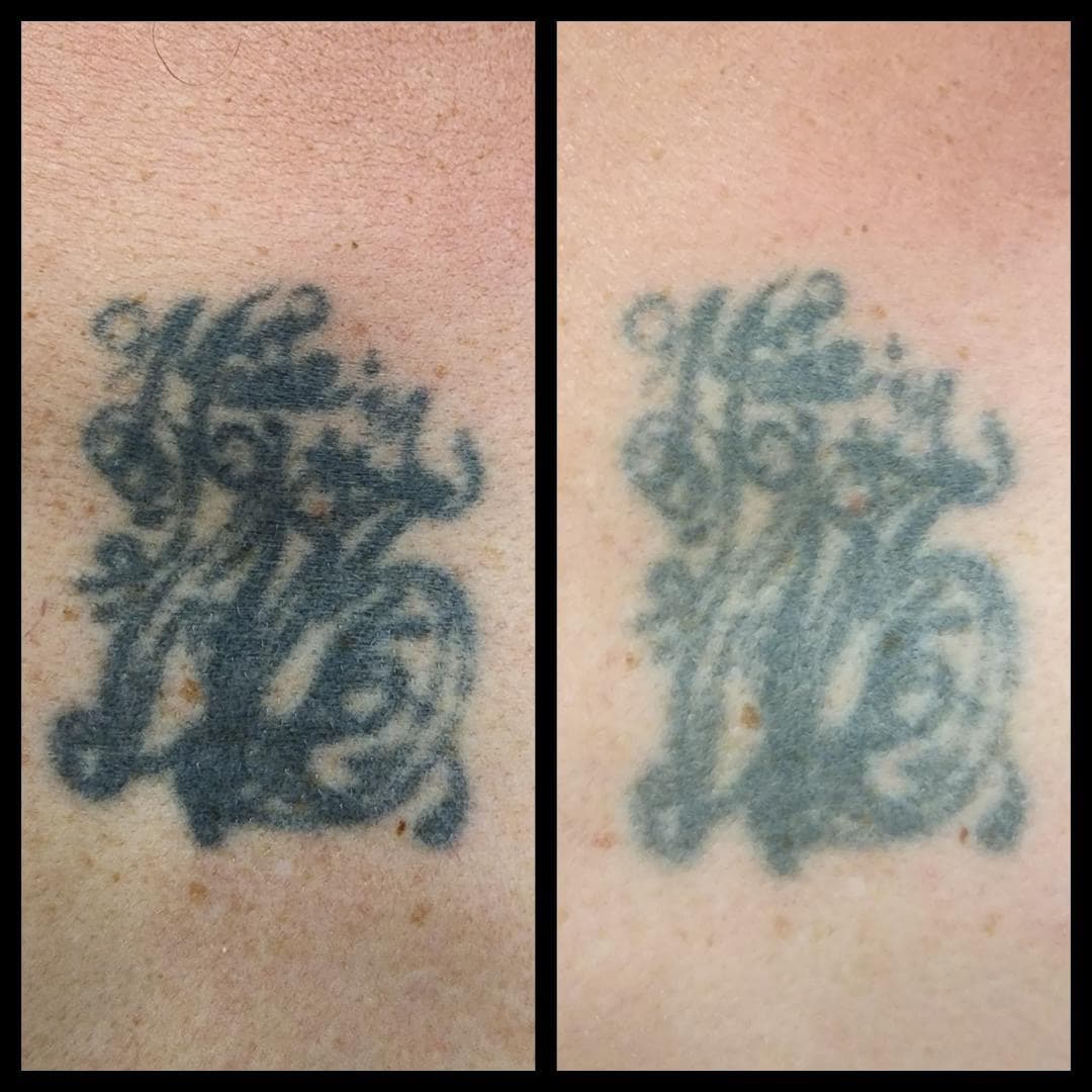 1 session done of tattoo removal. By Kat