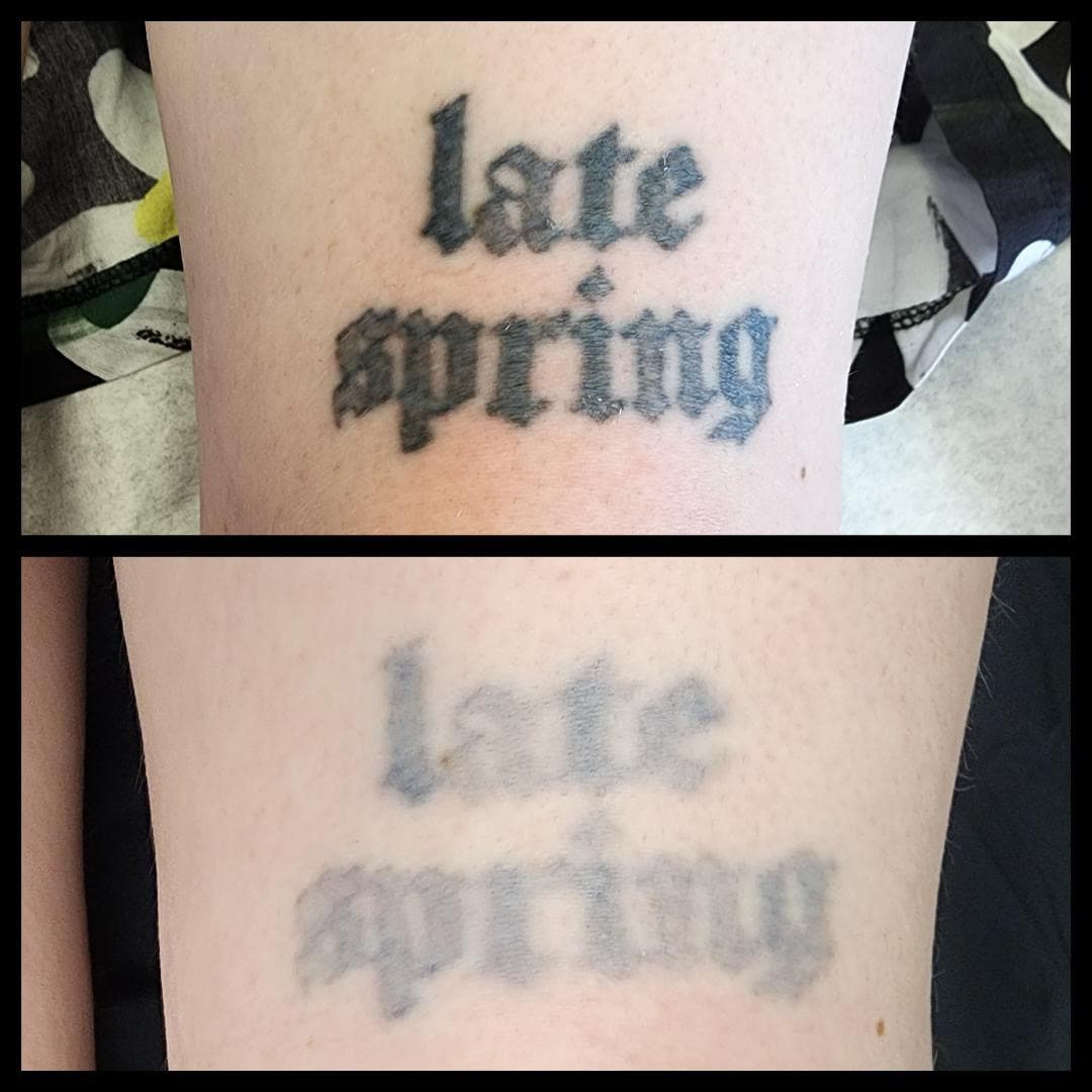 Tattoo removal journey. By Kat