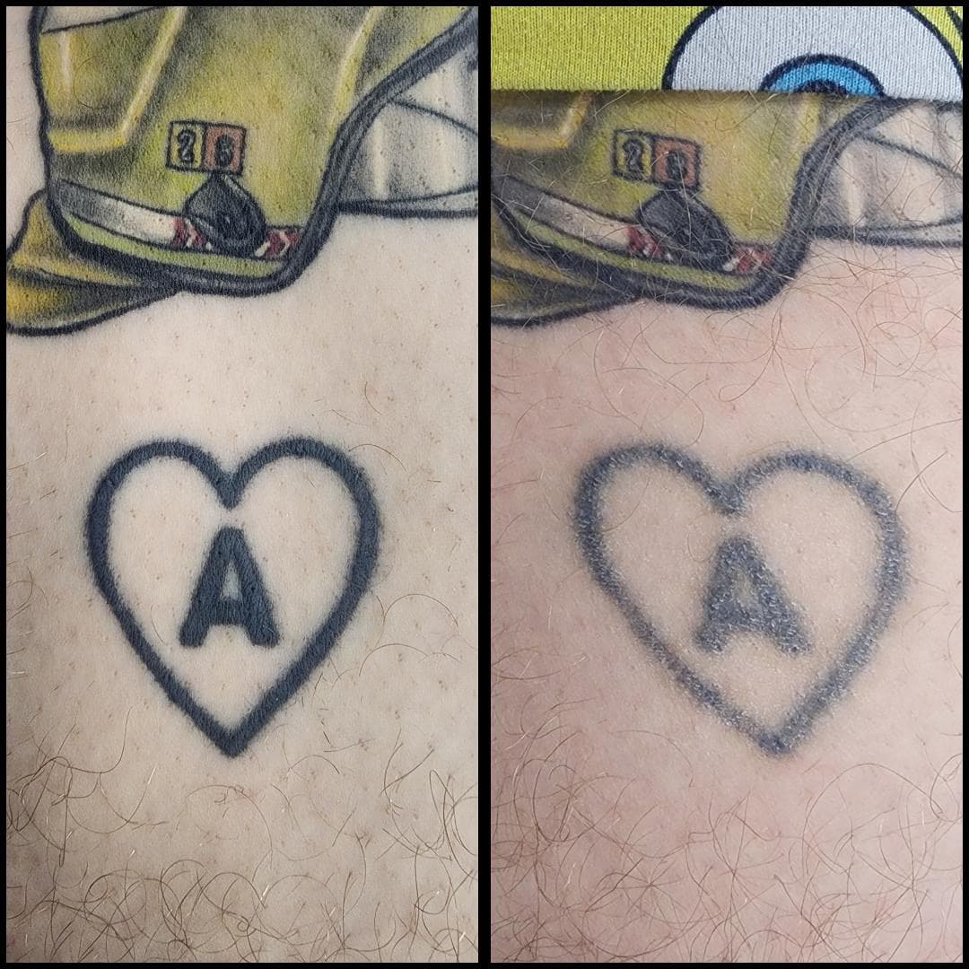 Tattoo removal for a cover up. By Kat