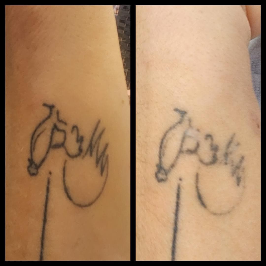 Just one session of tattoo removal. By Kat