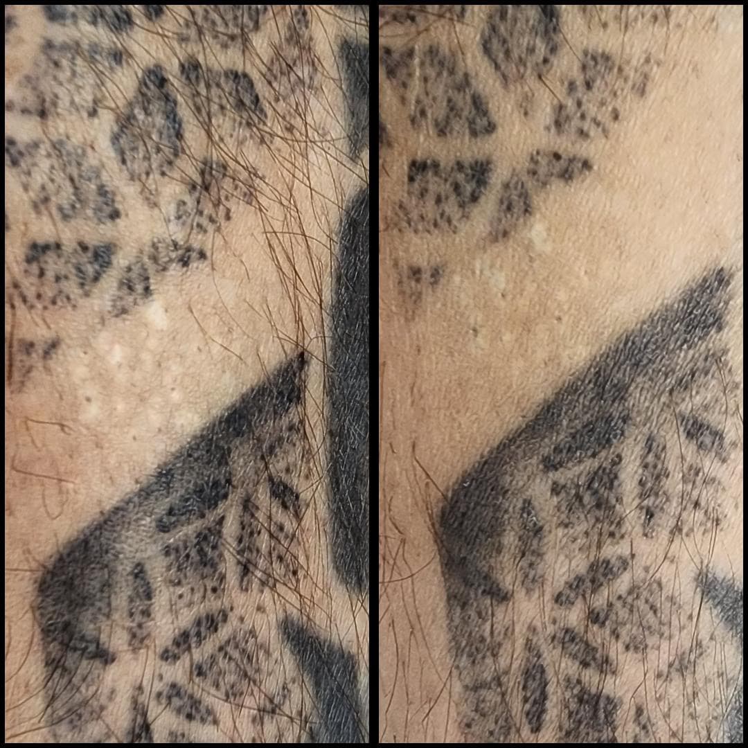 Removing white pigment dots. This one session. By Kat