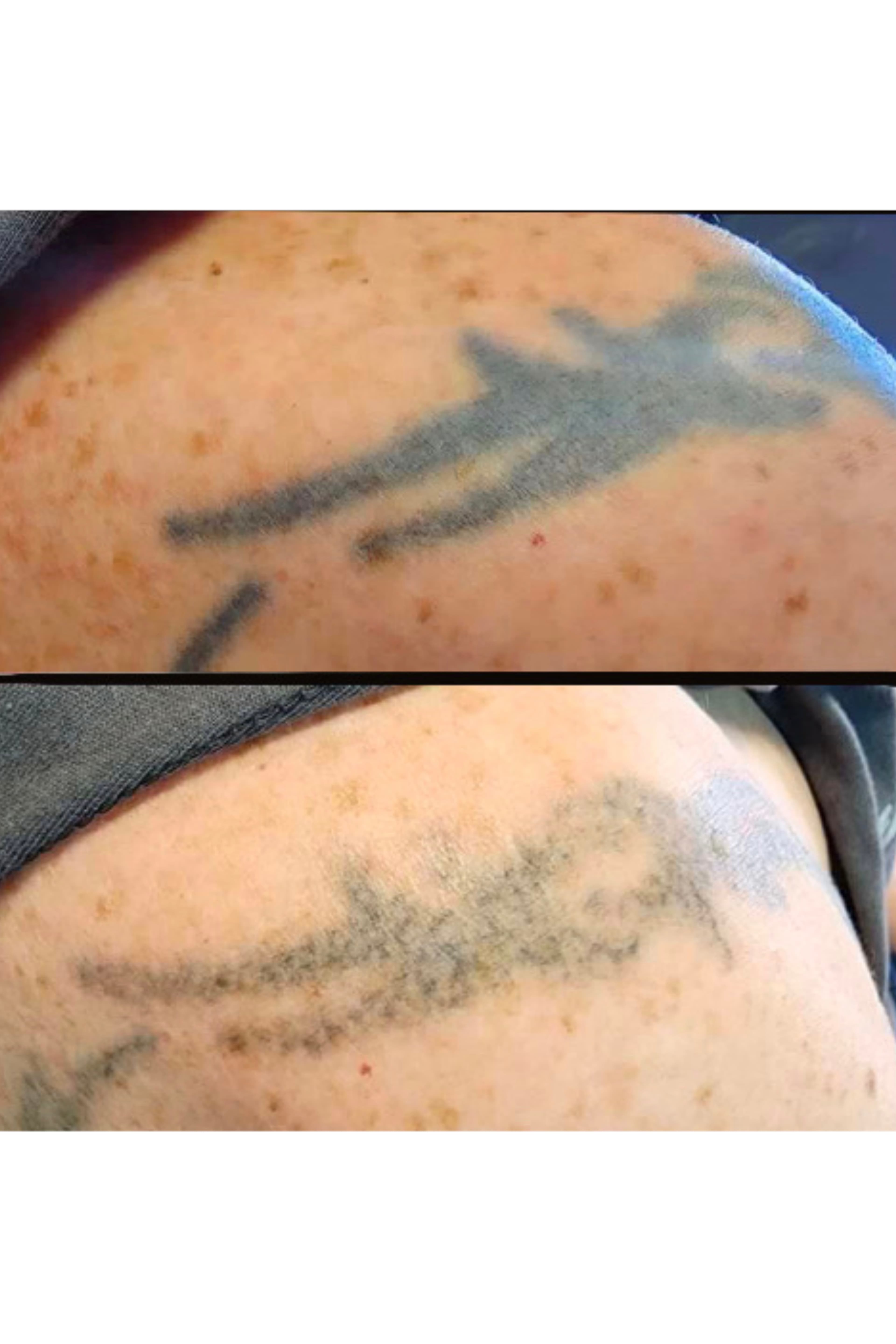 2 laser sessions down. By Kat