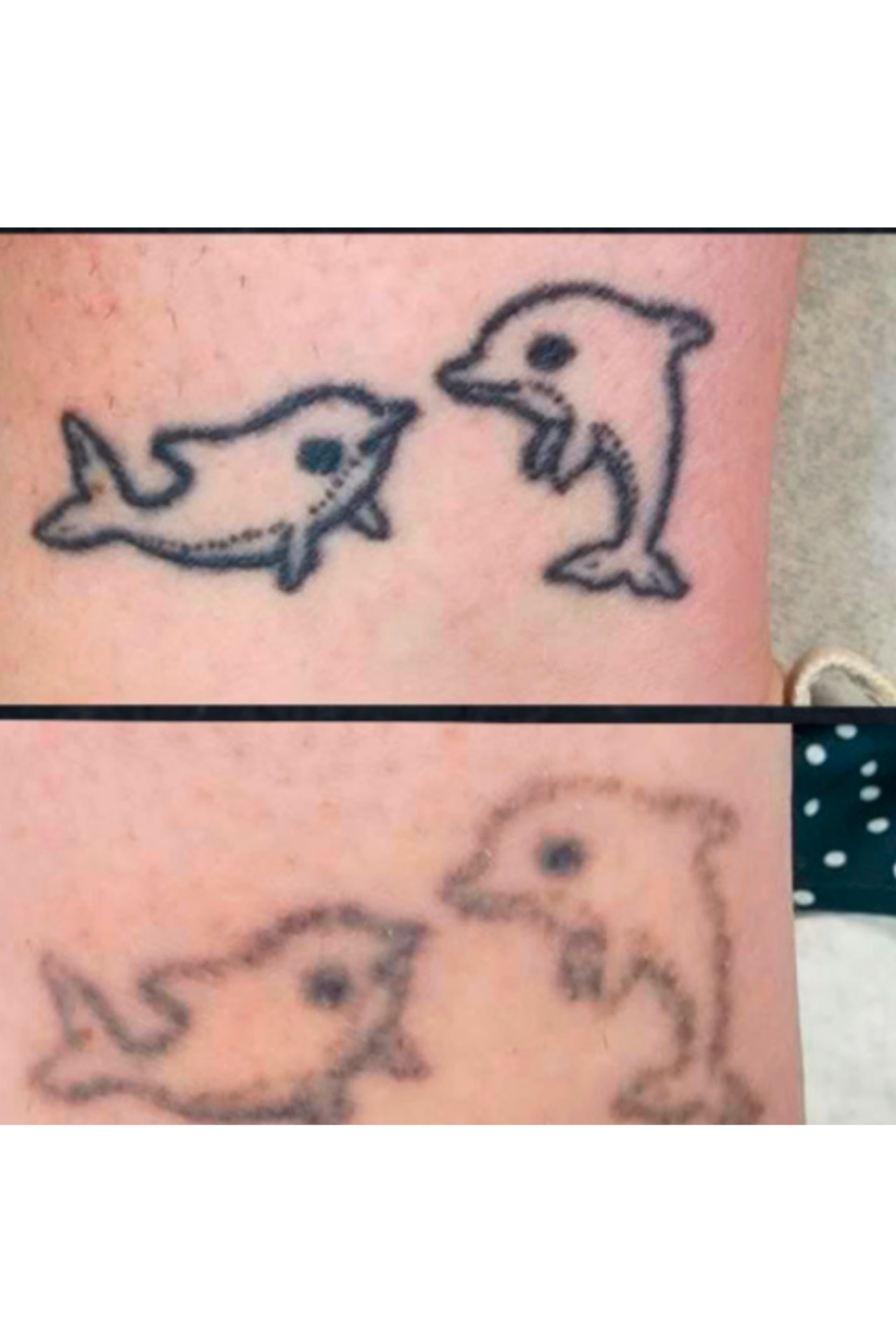 Tattoo removal, 4 sessions down. By Kat