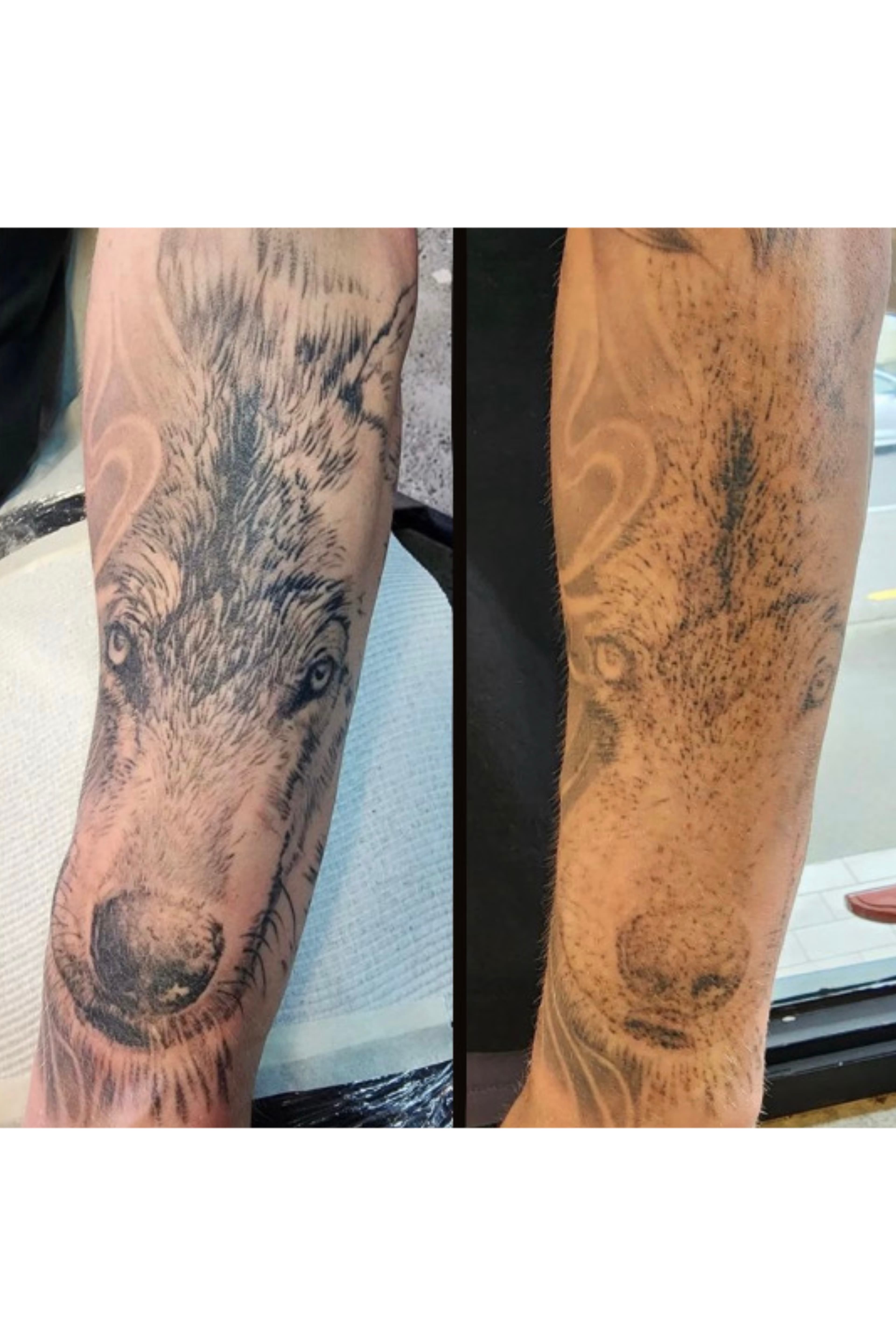 Tattoo removal. 2 sessions done. By Kat