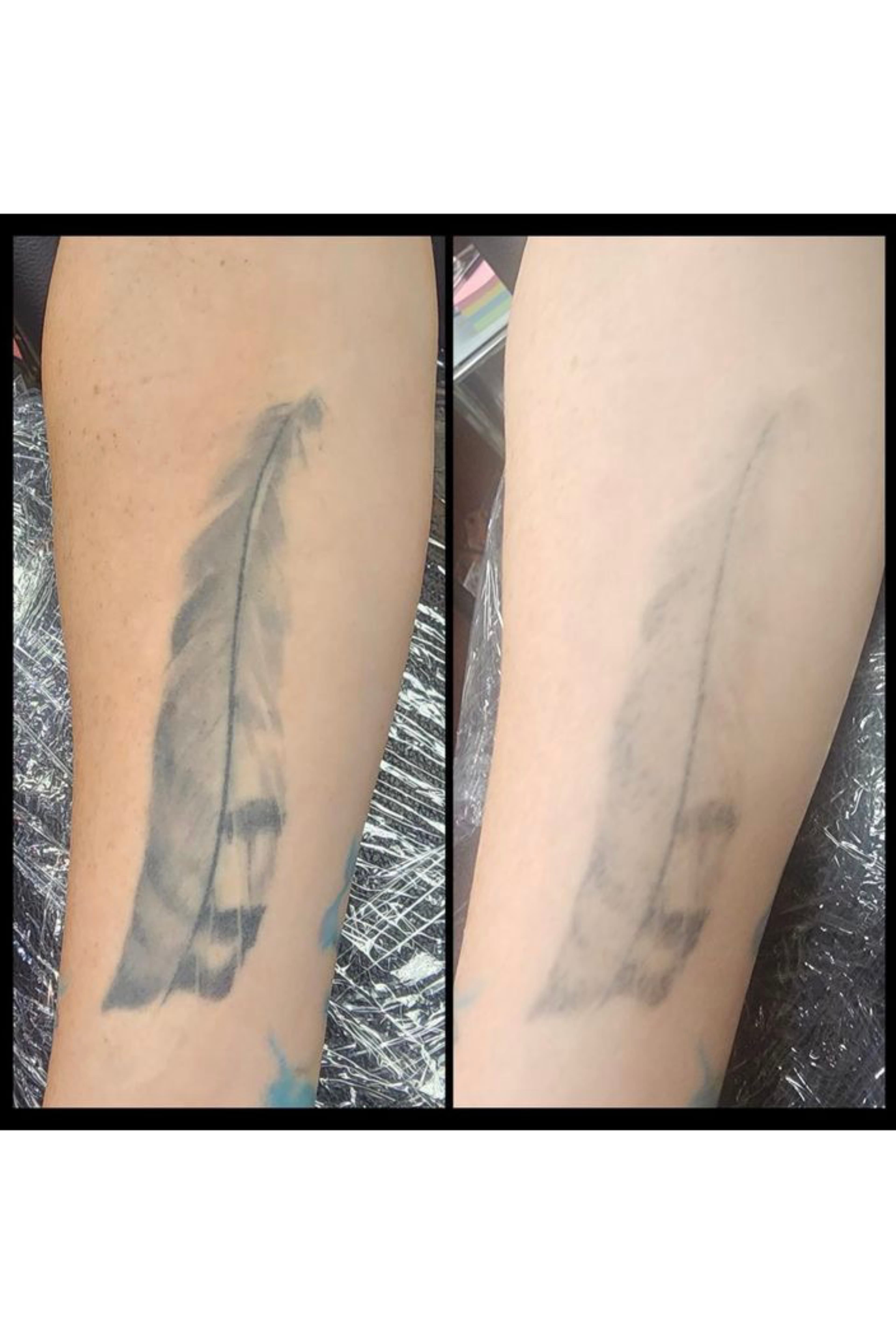 Just one laser sessions down. By Kat