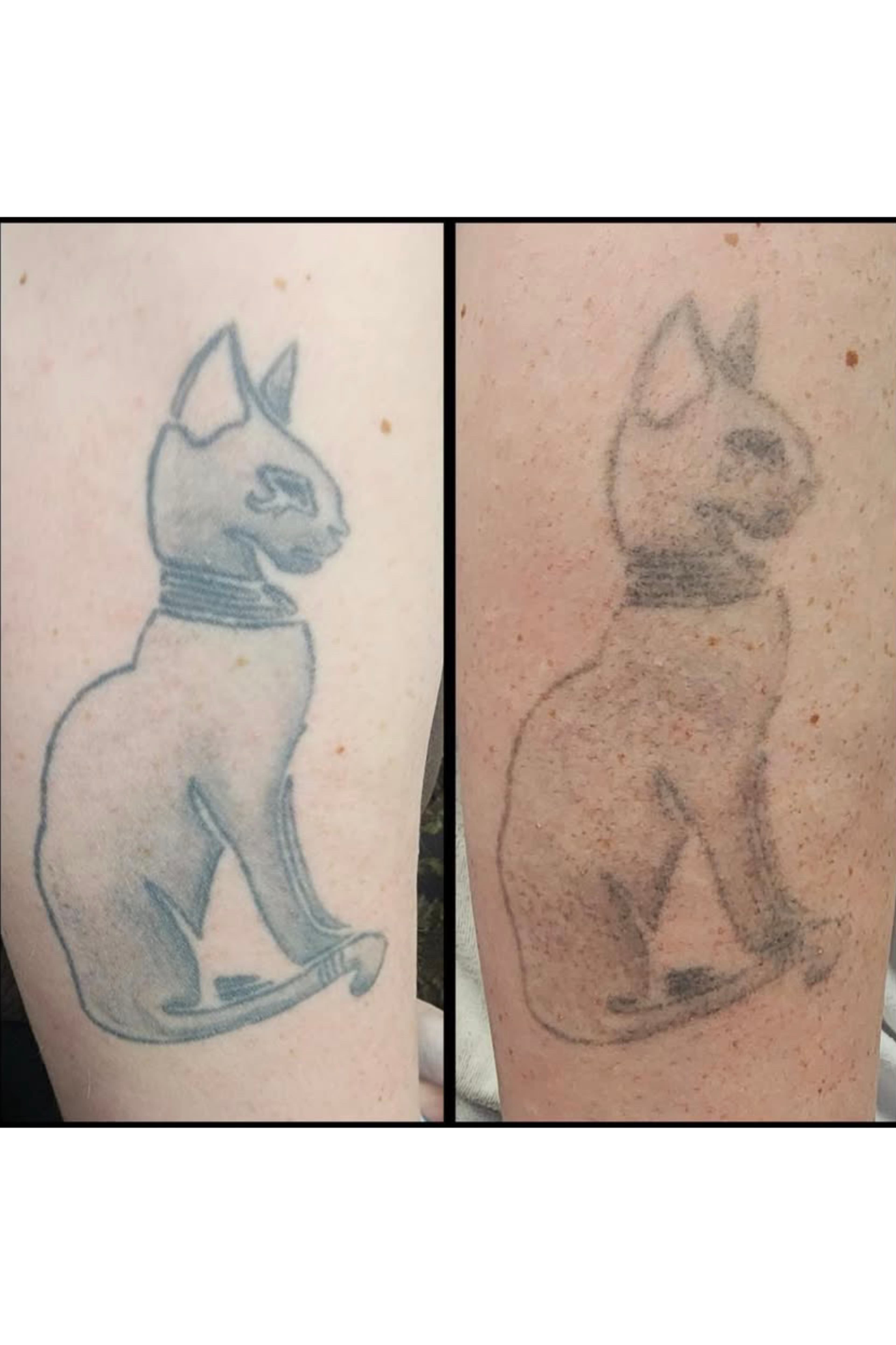 Tattoo removal for a cover up. By Kat