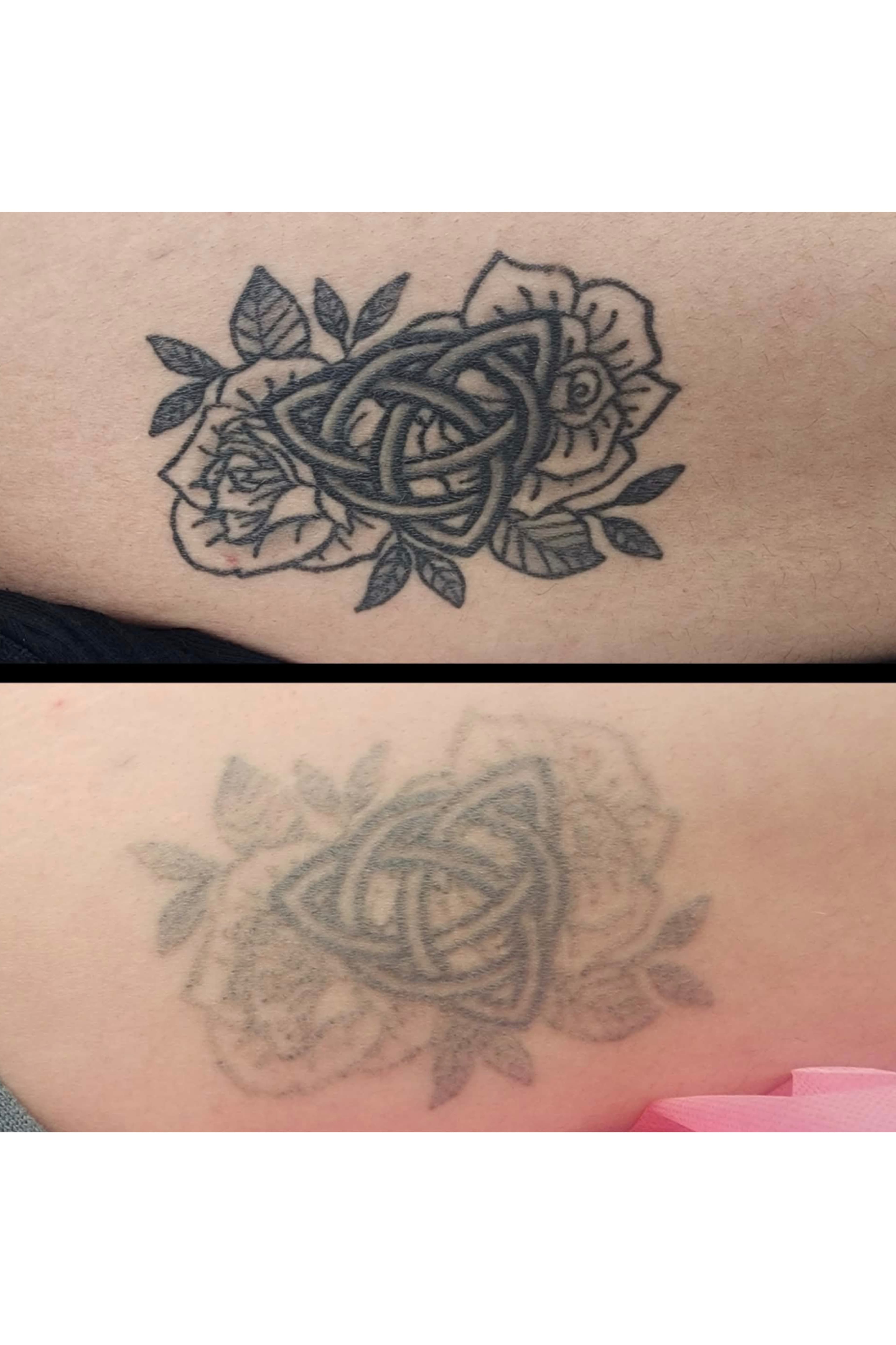 Tough laser this one. Very dark. Lightened down for a cover up. Had 6 sessions. By Kat