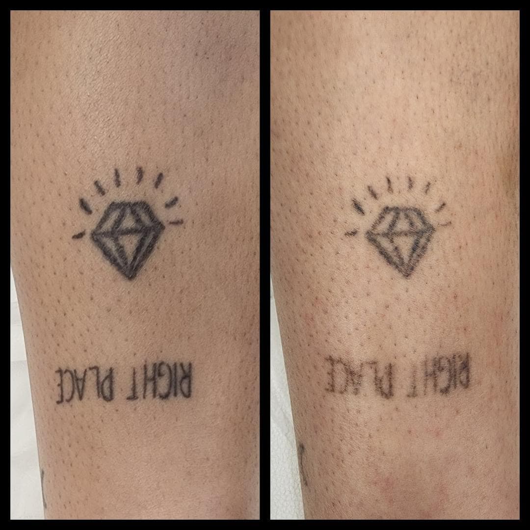 Tattoo removal, 2 sessions down. By Kat