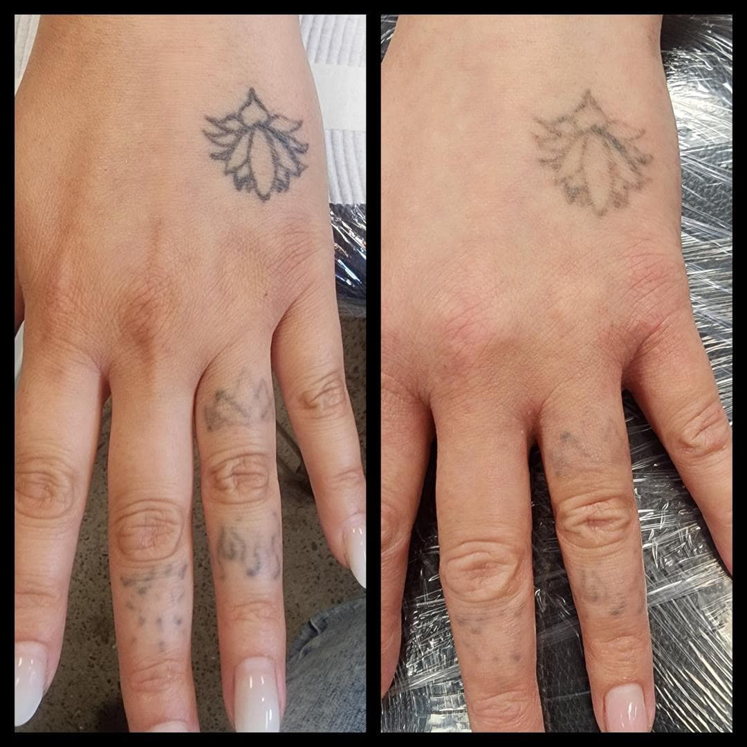 Removing unwanted hand tattoos. By Kat