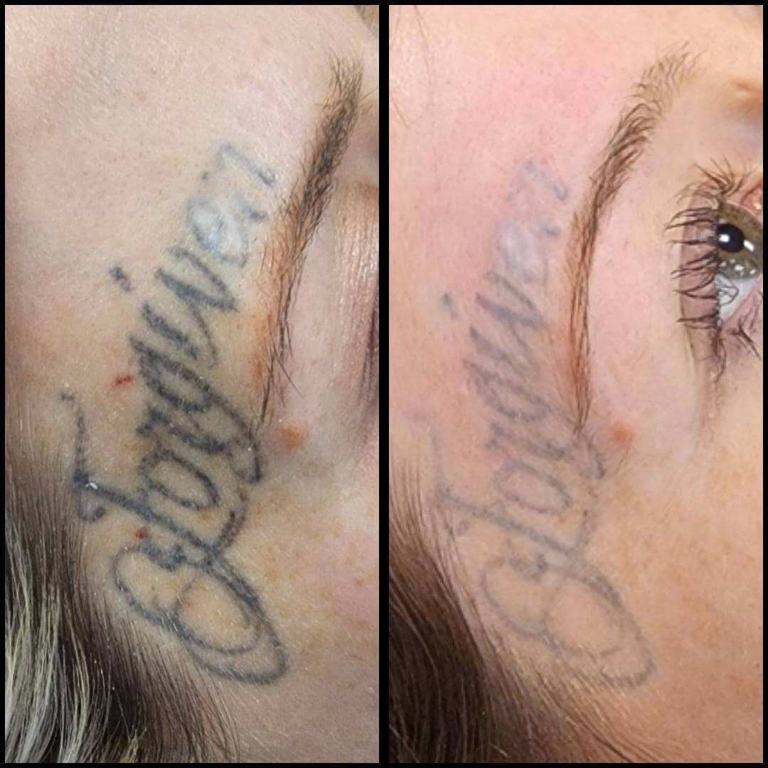 Before and after tattoo removal. Facial removal. By Kat