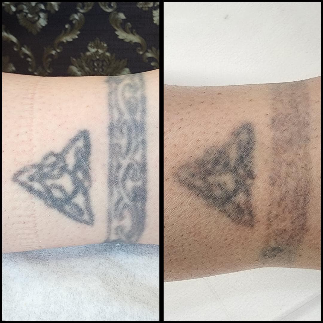 Tattoo removal. By Kat